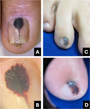 Hematoma. (A) Clinical: oval-shaped, blackish appearance; (B) Onychoscopy: purplish hue, globules and distal streaks; (C) Clinical: appearance of a darkened longitudinal streak; (D) Onychoscopy: purplish to bluish hue, sinuous borders, distal globules, pigment within the cuticle transparency simulating pseudo-Hutchinson and leukonychia at the site of trauma.