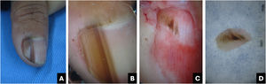 Melanoma. (A) Clinical: light brown to darkened longitudinal melanonychia; (B) Onychoscopy: light to dark brown streaks with apparent parallelism, pigment extends beyond the cuticle; (C) Intraoperative onychoscopy: irregular lines with light brown pigment, dark brown central amorphous area, and some asymmetric brown and darkened spots; (D) Ex vivo onychoscopy: exhibits the in vivo findings.