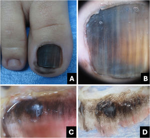 Melanoma. (A) Clinical: total blackened brown melanonychia with Hutchinson