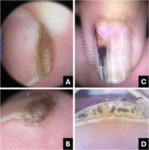 Onychomatricoma. (A) Onychoscopy (nail plate surface): homogeneous brownish longitudinal streak; (B) Onychoscopy (free edge): thickening of the nail plate; (C) Onychoscopy (nail plate surface): white longitudinal streaks, proximal dilated vessels, irregular red to darkened pigment; (D) Free edge: thickening of the plate with holes.