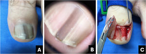 Onychocytic matricoma: (A) Clinical: homogeneous gray-blackened longitudinal streak; (B) Onychoscopy: homogeneous gray-blackened longitudinal streak with subungual hyperkeratosis; (C) Intraoperative: thick, pigmented linear tumor from the matrix to the hyponychium.