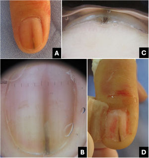 Onychopapilloma. (A) Clinical: longitudinal erythro/melanonychia; (B) Onychoscopy (nail plate surface): pointed erythro/melanonychia at the lunula; (C) Onychoscopy (free edge): localized subungual hyperkeratosis. (D) Intraoperative: pigmented filiform tumor from the distal matrix to the hyponychium.