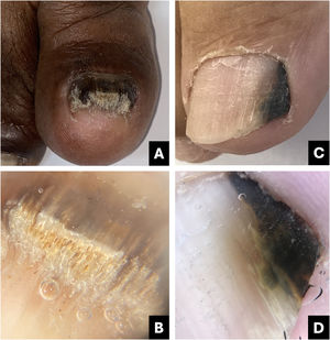 Onychomycosis. (A) Clinical: thickened and blackened nail; (B) Onychoscopy: subungual hyperkeratosis with ruin appearance, wide distal streaks, yellowish-white; (C) Clinical: irregular darkened band, wider at the distal portion (inverted triangle sign); (D) Onychoscopy: irregular black longitudinal streak, with wide yellowish-white distal streaks.