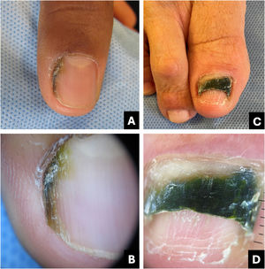 Onychobacteriosis. (A) Clinical: irregular brownish-black streak; (B) Onychoscopy: greenish-brownish-yellowish hue; (C) Clinical: dark greenish onycholysis; (D) Onychoscopy: dark greenish-yellowish color.