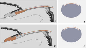 Schematic drawing of matrix pigment in correlation to depth of nail plate pigmentation. (A and B) Melanonychia with origin in distal nail matrix will be found in lower part of free nail edge. (C and D) Melanonychia with origin in proximal nail matrix will be found in upper part of free nail edge.