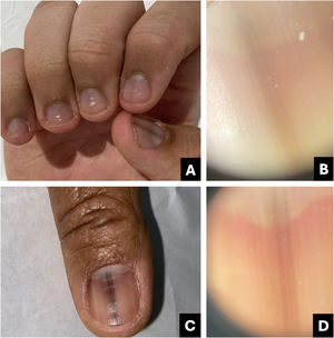 Melanocytic activation. (A) Clinical: multiple nails with gray to blackened streaks; (B) Onychoscopy: homogeneous gray streak lighter than is visible to the naked eye; (C) Clinical: Gray to darkened streak; (D) Onychoscopy: homogeneous gray streak lighter than is visible to the naked eye.