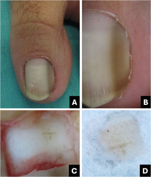 Melanocytic activation. (A) Clinical: brownish-gray longitudinal streak; (B) Onychoscopy: homogeneous brownish-gray pattern; (C) Intraoperative Onychoscopy: brownish-gray pigment with regular lines and some dots; (D) Ex vivo Onychoscopy: exhibits the in vivo findings.