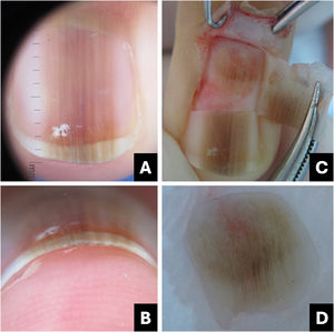 Melanocytic nevus. (A) Onychoscopy of the nail plate surface: light brown, dark, and gray longitudinal streaks, continuous individually and parallel to each other; (B) Onychoscopy of the free edge: pigment throughout the thickness of the nail plate; (C) Intraoperative Onychoscopy: regular lines with light brown pigment and some areas of thickening or blotches; (D) Ex vivo Onychoscopy: exhibits the in vivo findings.