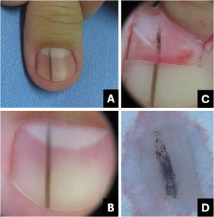 Melanocytic nevus. (A) Clinical: darkened longitudinal streak; (B) Onychoscopy: regular dark brown lines with tiny granules; (C) Intraoperative Onychoscopy: lines with darkened brown pigment and some globules or blotches; (D) Ex vivo Onychoscopy: exhibits the in vivo findings.