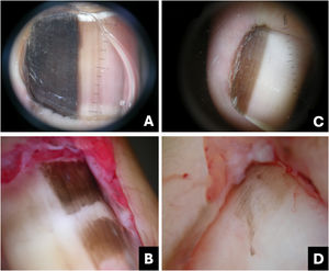 Lentigo simplex. (A) Onychoscopy: homogeneous darkened streak with regular brown streaks; (B) Intraoperative onychoscopy: homogeneous brown lines without blotches; (C) Onychoscopy: homogeneous, brown-blackened streak; (D) Intraoperative onychoscopy: homogeneous grayish-brown lines without blotches. (Courtesy of Dr. Sérgio Hirata).