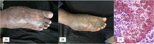 (A) Patient 5: Mycetoma caused by Madurella pseudomycetomatis, before starting treatment. (B) At the end of treatment. (C) Grain made up of thick, brown hyphae (Hematoxylin& eosin, 10×).