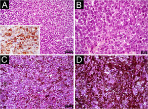 Oral Melanoma. (A) Diffuse proliferation of plasmacytoid and epithelioid cells containing hyperchromatic nuclei and absence of melanin pigment (Scale bar: 50 μ). Observe the immunostaining for melan TA (inset). (B) Detail of the previous image showing evident but not prominent nucleoli and mitotic figures (Scale bar: 20 μ) (C) Diffuse proliferation of epithelioid and spindle-shaped cells permeated by dark brown melanin pigment (Scale bar: 50 μ) (D) Area showing clotted pigment assuming the shape of epithelioid and spindle-shaped cells (Scale bar: 20 μ).