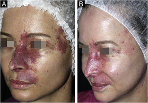 Patient with clearing >75% before (A) and after (B) ten sessions of isolated intense pulsed light.