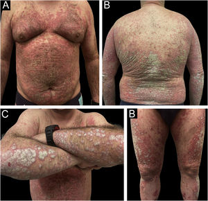 Example of a real patient prior to treatment with risankizumab. The involvement was generalized, with an initial staging of PASI 38.4; BSA 46%, and DLQI 28.