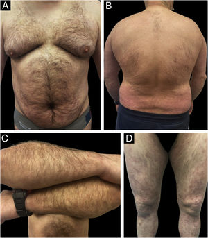 Example of a real patient (Patient of Fig. 2) after 6 months of treatment with risankizumab. The staging at 6 months was PASI 1.2; BSA 2%, and DLQI 4.