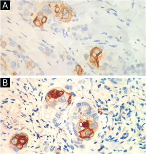 Immunohistochemistry positivity for EMA (A) and CEA (B), confirming the presence of ductal differentiation.