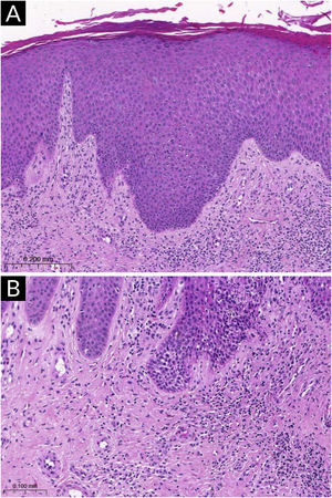 Histopathology of atopic dermatitis (subacute lesion). (A) Epidermis with irregular acanthosis, hyperkeratosis and focal parakeratosis, associated with mild spongiosis (Hematoxylin & eosin, ×200). (B) Inflammatory lymphocytic infiltrate of the superficial dermis, predominantly perivascular, with sparse eosinophils (Hematoxylin & eosin, ×400).