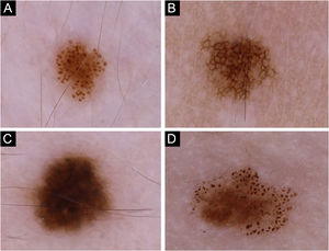 Nevi of the participants exhibiting four major dermoscopic patterns: (A) Globular, (B) Reticular, (C) Homogeneous, and (D) Complex.