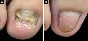 (A) Onychomycosis affecting the right hallux due to Fusarium sp. refractory to pharmacological treatment. (B) After six months of nail avulsion, followed by treatment with itraconazole (200mg pulse), terbinafine (500mg pulse) and micolamina nail polish.