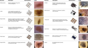 Dermoscopic patterns of acral pigmented lesions.