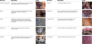 Dermoscopic structures of acral pigmented lesions.