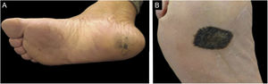 Variation in delimitation of acral melanoma. (A) Poorly delimited acral melanoma. (B) Well delimited acral melanoma.