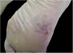 Hypomelanotic plantar acral melanoma.