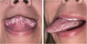 Whitish plaques on the tongue.