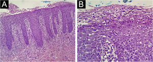 Histopathological findings of the tongue lesion. (A) Squamous mucosa showing hyperplastic psoriasiform epithelium (Hematoxylin & eosin, ×100). (B) Munro’s microabscess (arrow; Hematoxylin & eosin, ×400).