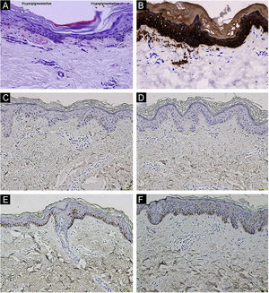 Histopathological and immunohistochemical observation. (A) Hematoxylin-eosin stain showed hyperkeratotic epidermis with mild hyperpigmentation and focal basal liquefaction degeneration, amorphous eosinophilic deposits and sparse melanophagesin the papillary dermis (left side); and hyperkeratotic and partially atrophic epidermis with basal layer hypopigmentation (right side) (original magnification ×200). (B) Cytokeratin 34βE12 immunostaining revealed amyloid deposits in the upper dermis (original magnification×200). (C‒F) GPNMB immunoreactivity was weak in hyperpigmented lesion (C) and absent in hypopigmented lesion (D) of II5 patient, and moderate in forearm skin of II4 carrier with c.565C>T (E) and normal control (F) (original magnification ×200).