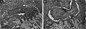 Transmission electron microscopy. (A) Cytoplasmic Amyloid-like Filaments (AF) in 2 degenerated basal Keratinocytes (KC), Tonofilaments (Tf) in adjacent normal keratinocytes, partial disruption (arrowheads) of basal lamina and cytomembrane between the uppermost amyloid deposit and the degenerated basal cell, and fibrillar bodies (asterisks) in the papillary dermis (original magnification x8,000). (B) A Histiocyte (H) lay between 2 partly degenerated basal keratinocytes containing AF and Tf, partial disruption (arrowhead) of basal lamina and cytomembrane, and fibrillar bodies (asterisks) in the papillary dermis (original magnification x15,000).