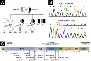 Genogram and GPNMB sequencing and protein structure. (A) Pedigree of the proband. Asterisks represent the participants with genetic testing. (B) Sanger sequencing of the proband showed compound heterozygous mutations of c.565C>T in exon 5 and c.1092delT in exon 7 of GPNMB. (C) Structure and 16 mutations of human GPNMB protein originating from 17 GPNMB mutants (p.V240Dfs*24 deriving from mutants c.717_718delTG and c.719_720delTG). A novel c.1092delT mutation in this pedigree is marked in red. Mutants GPNMB-1 (a splice isoform of GPNMB) with an in-frame 12-amino acid insertion (underlined), and RGD and Di-Leucine motifs are also shown. SIG, Signal Sequence Domain; NTD, N-Terminal Domain; PKD, Polycystic Kidney Disease-like domain; KRG, Kringle-like domain; TM, Transmembrane Domain; CTD, C-Terminal Cytoplasmic Domain.