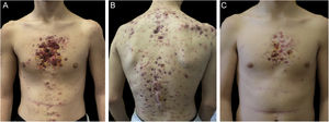 Upon clinical presentation, both patient 1 (A‒B) and patient 2 (C) exhibited ulcerative acneiform lesions on their chest, leading to a diagnosis of acne fulminans.