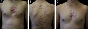 After six months, the patient 1 (A‒B) and the patient 2 (C) had atrophic scars on their chest and back.