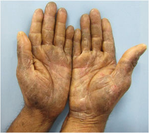 On examination, erythematous, brownish plaques with lichenification, desquamation, erosions and fissures are observed on the hands.