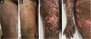 (A) Diffuse erythema and desquamation at disease onset. (B) Reduction in erythema with some bullae. (C and D) Exfoliation of large areas resembling TEN.