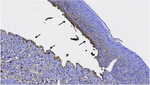 Immunohistochemistry with anti-IgG antibody showing positivity on the floor and roof of the bulla (arrows).