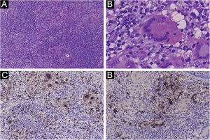 The histopathological findings and immunohistochemistry. (A) Prominent histiocytic infiltrate in a background of inflammatory cells (Hematoxylin & eosin, 100×). (B) Large histiocytes with engulfed intact lymphocyte showing emperipolesis (Hematoxylin & eosin, 400×). (C) The histiocytes showing positive for CD68. (D) The histiocytes showing positive for S100. (C, 200×; D, 200×).