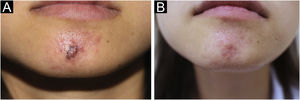 Clinical appearance of CRDD. (A) Clusters of red papules that coalesce into plaques on the mandible before treatment. (B) The lesion was flat and remarkably improved after three sessions of pulsed dye laser treatment at one-month intervals.