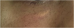 Xanthelasma-like lesion.