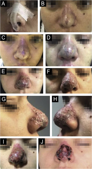 (A‒J) Evolution since the day of application (A); tissue suffering (B‒D). (E–J) Inflammation and necrosis.