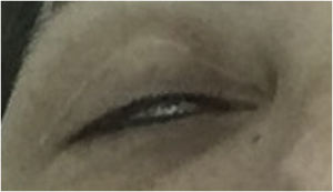 Loss of the ability to close the eyelids due to inadequate relaxation of the fibers of the inferior orbicularis muscle. Note: upper blepharoplasty scar.