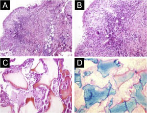 (A‒D) Histopathology of the nodule. (A) Deep reticular dermis with mixed inflammatory and tuberculoid granulomatous infiltrate in palisade surrounding amorphous and eosinophilic material with the characteristics of hyaluronic acid (Hematoxylin & eosin, ×100). (B) Detail showing the palisaded tuberculoid granulomatous infiltrate (Hematoxylin & eosin, ×200). (C) Amorphous and eosinophilic material surrounded by intact and degenerated neutrophil leukocytes (Hematoxylin & eosin, ×200). (D) Strongly positive colloidal iron staining demonstrating hyaluronic acid. Colloidal iron, ×200.