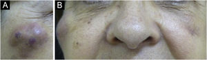 (A‒B) Appearance of nodules in the right malar region, 45 days after the procedure and 30 days after the appearance of the contralateral nodule, with the same characteristics. The patient was already taking broad-spectrum antibiotics due to the presence of the nodule on the left. It is worth noting that there are three nodules, probably at the implant injection sites.