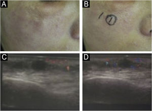 (A‒D) Inflammatory reactivation in sites treated with biomaterial after distant infection, in this case, tonsillitis. (C and D) Ultrasound appearance: increased vascularization around the biomaterial.