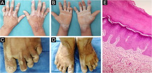 Physical examination and histopathology image. (A) Bilateral linear keratotic lesions at dorsum of metacarpophalangeal joints and right wrist. (B) Bilateral palmar keratoderma with “honeycomb” appearance. (C) Pseudoainhum at third and fourth toes. (D) Bilateral dorsal feet starfish-shaped keratotic lesions. (E) Orthokeratotic hyperkeratosis. (Hematoxylin & eosin, ×100).