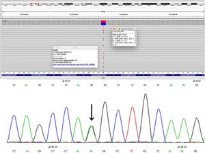 Mutation in the GJB2 gene in sporadic case of Vohwinkel syndrome presented in this report by direct sequencing of GJB2 in our patient showing a heterozygous state of the mutation c.175G>A (p. Gly59Ser) in exon 2.