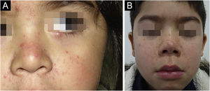 (A) 4-year-old girl with erythema, papules and pustules in the facial area; (B) 8-year-old boy with basal erythema and papules in the facial area.