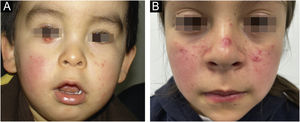 (A) 1-year-old child with erythema and micropapules on cheeks. An erythematous- yellowish nodule on the free edge of the right lower eyelid stands out as the main manifestation of demodicosis. (B) 9-year-old girl with centrofacial erythema associated with a significant number of papules and pustules in the facial area.