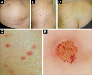 Clinical findings. Clinical pictures showed reddish papules and nodules scattered from the left lower abdomen to the dorsal aspect of the hip, with a zonal arrangement (A‒C). Note that there were no eruptions from the center to the contralateral skin. A close-up view of the skin lesions illustrated non-fused, reddish papulo-nodules with center plugs in each (D), consisting with dermoscopic finding (E).